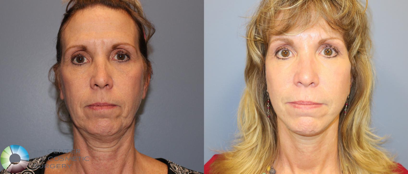 Before & After Neck Lift Case 826 View #2 View in Denver & Golden, CO