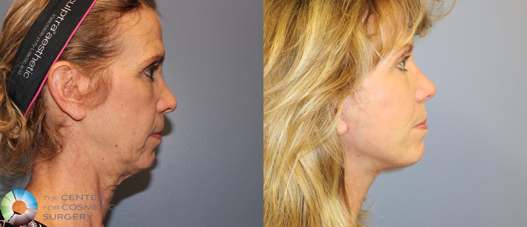 Before & After Neck Lift Case 826 View #3 View in Golden, CO