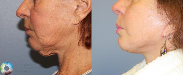 Before & After Neck Lift Case 827 View #1 View in Golden, CO