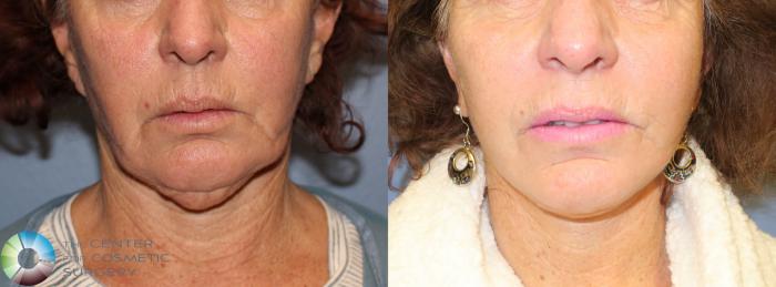 Before & After Neck Lift Case 827 View #2 View in Golden, CO