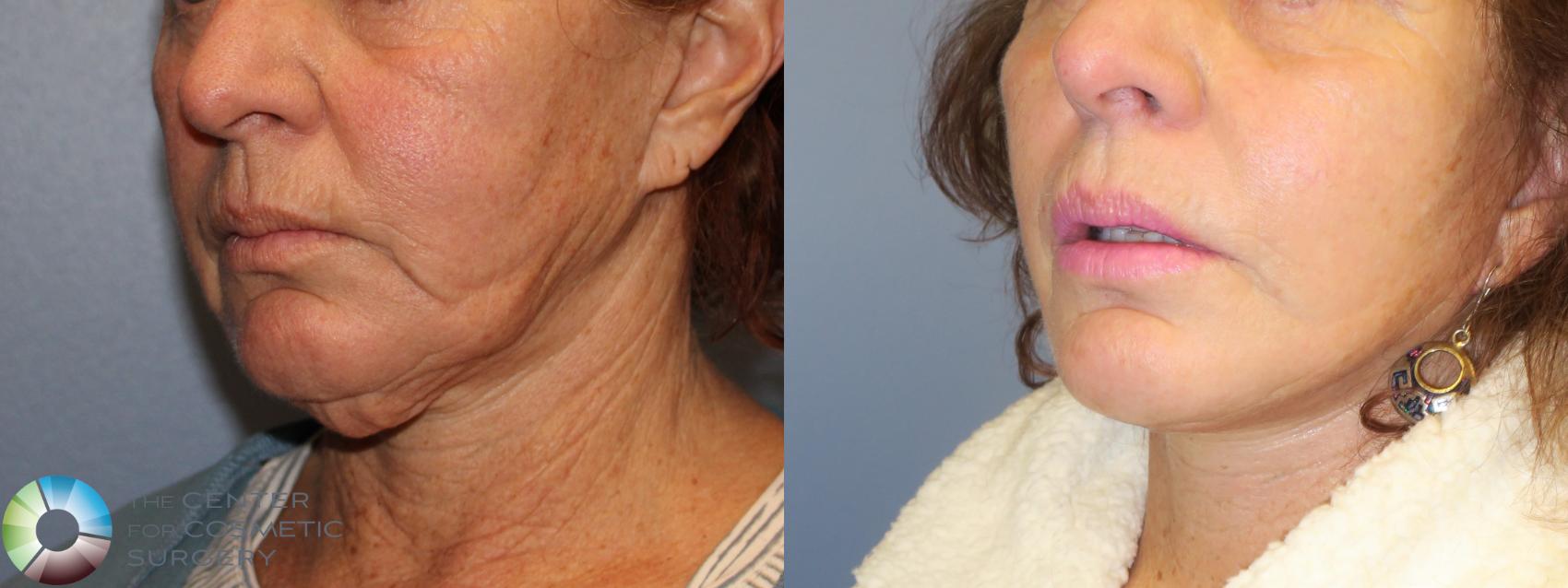 Before & After Facelift Case 827 View #3 in Denver and Colorado Springs, CO