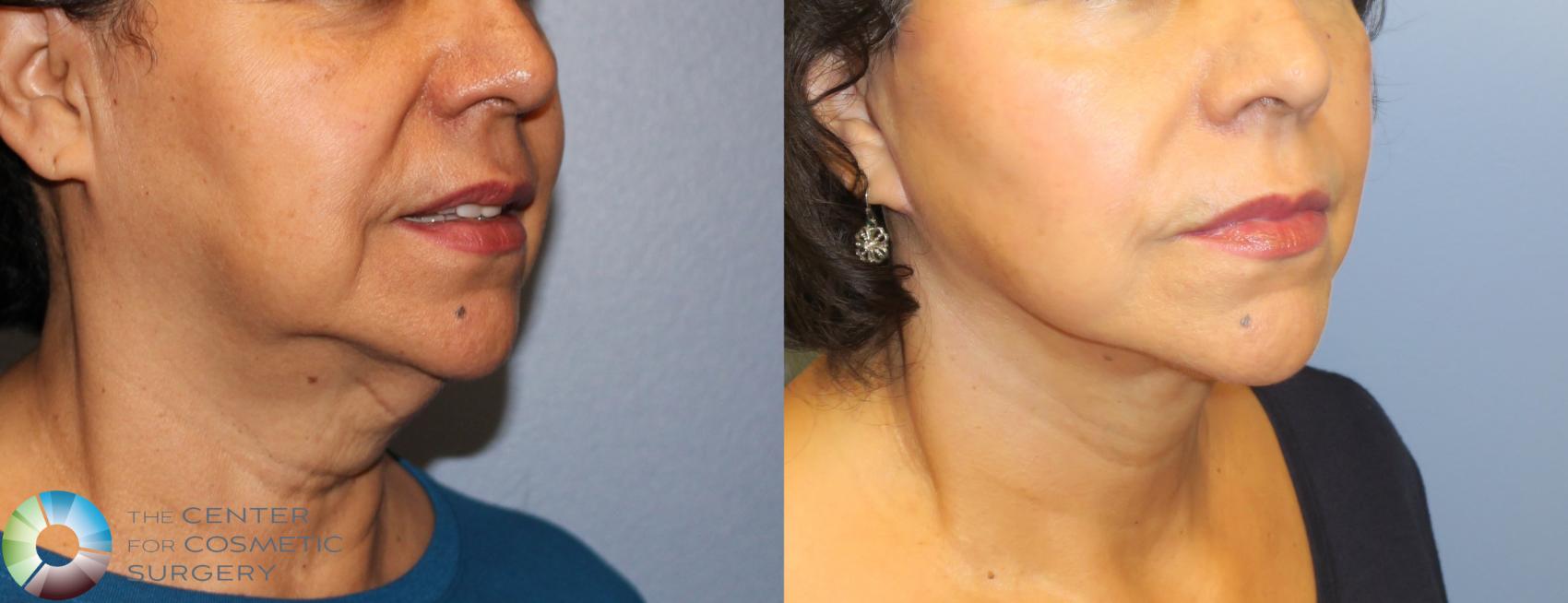 Before & After Neck Lift Case 898 View #2 View in Denver & Golden, CO