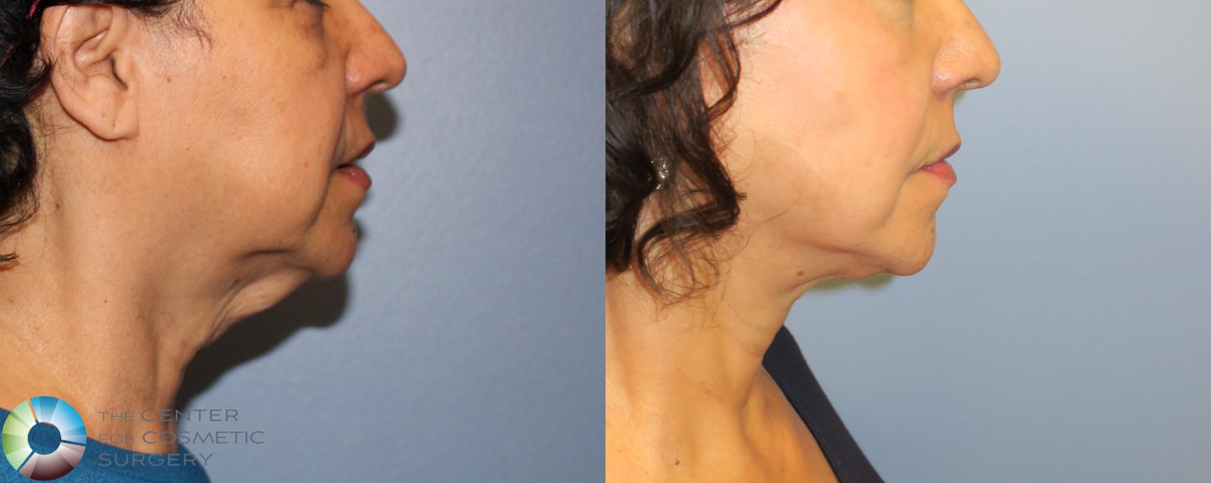 Before & After Mini Facelift Case 898 View #3 View in Denver & Golden, CO