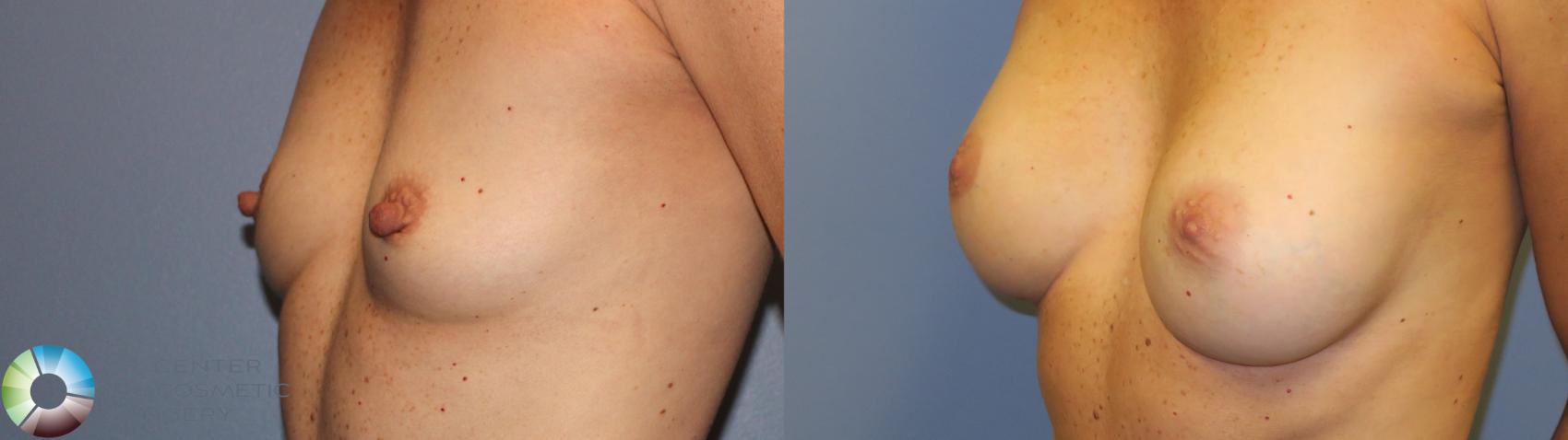 Before & After Nipple reduction Case 11216 Left Oblique View in Denver & Golden, CO