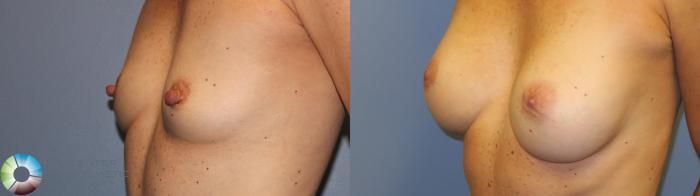 Before & After Nipple reduction Case 11216 Left Oblique View in Golden, CO
