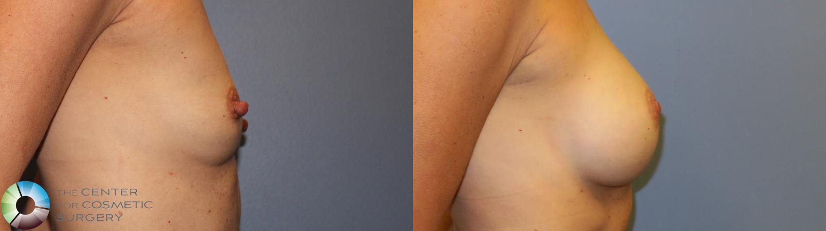 Before & After Nipple reduction Case 11216 Right Side View in Golden, CO