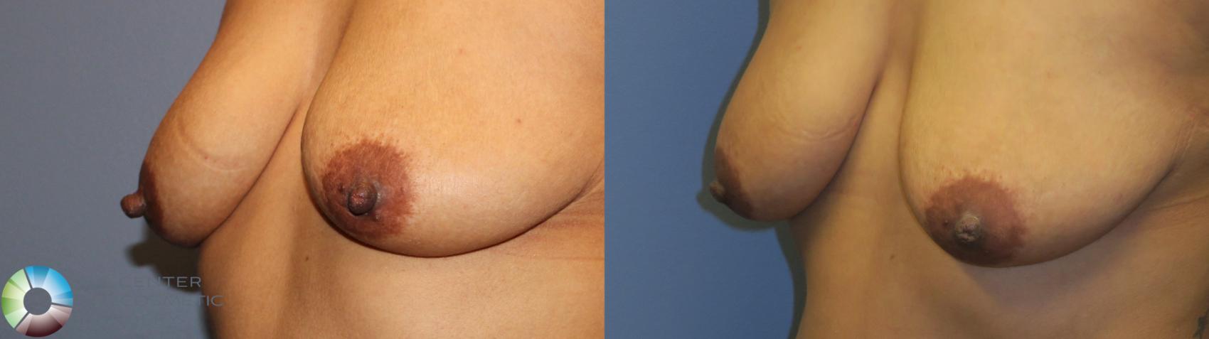 Before & After Nipple reduction Case 11344 Left Oblique View in Denver & Golden, CO