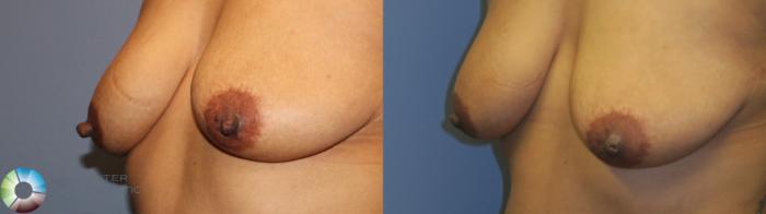 Before & After Nipple reduction Case 11344 Left Oblique View in Golden, CO