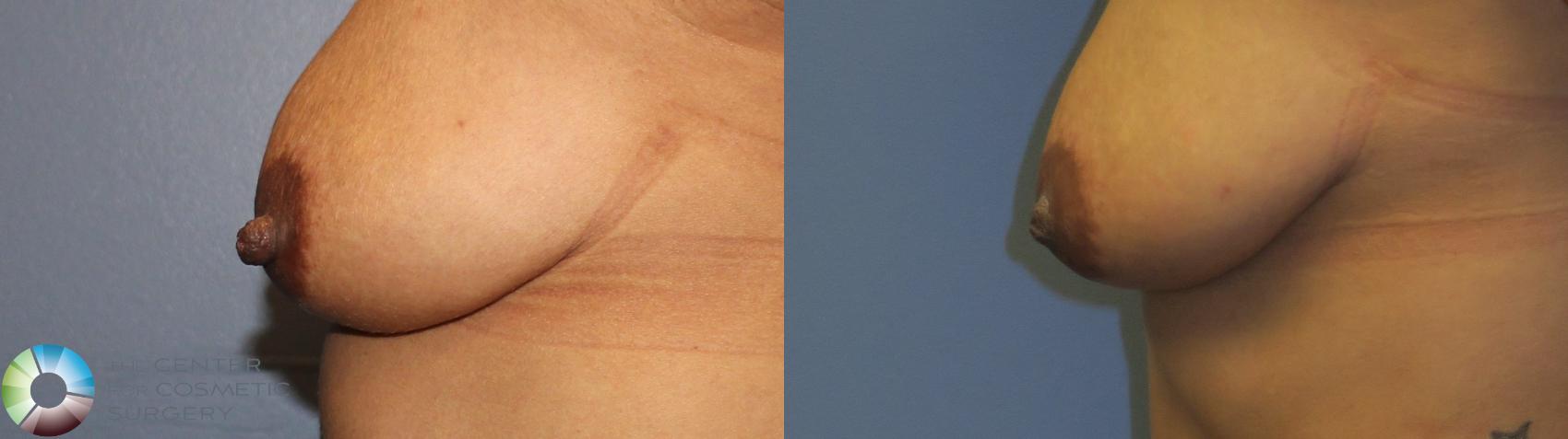 Before & After Nipple reduction Case 11344 Left Side View in Golden, CO