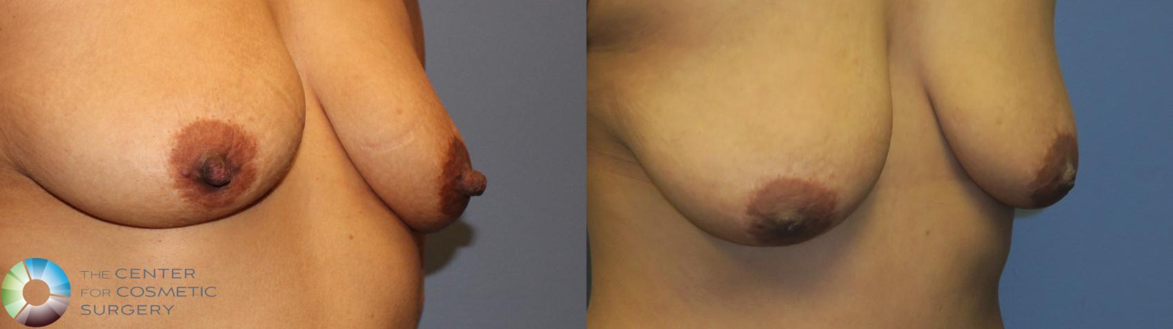 Before & After Nipple reduction Case 11344 Right Oblique View in Denver & Golden, CO