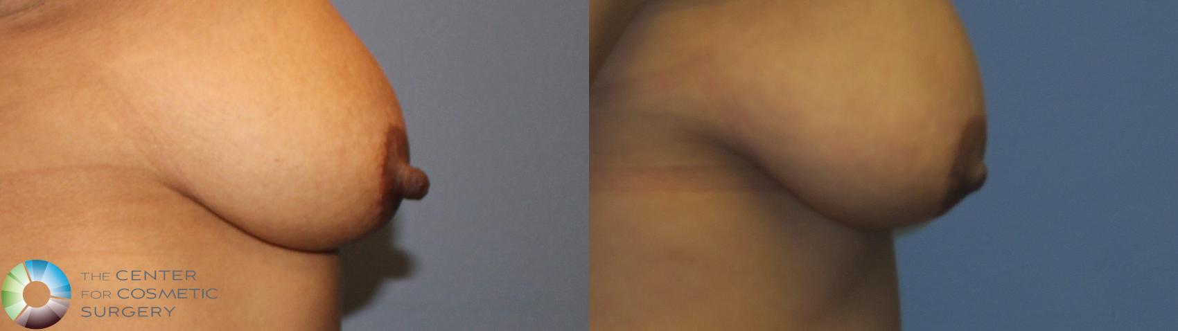 Before & After Nipple reduction Case 11344 Right Side View in Golden, CO