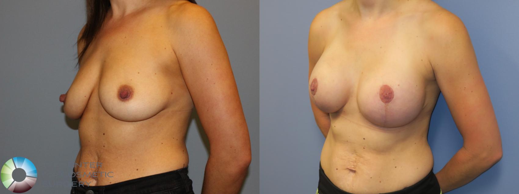 Before & After Nipple reduction Case 11345 Left Oblique View in Denver & Golden, CO