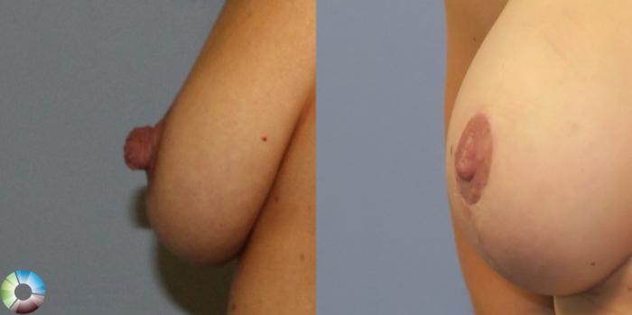 Before & After Nipple reduction Case 11345 Left Side View in Golden, CO