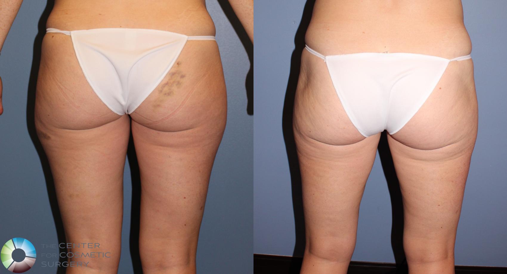 Before & After Power-assisted Liposuction Case 11384 Back in Denver, CO