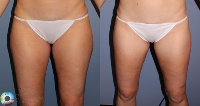 Before & After Power-assisted Liposuction Case 11384 Front in Denver, CO
