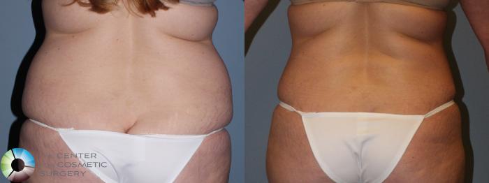 Before & After Power-assisted Liposuction Case 11412 Back View in Golden, CO