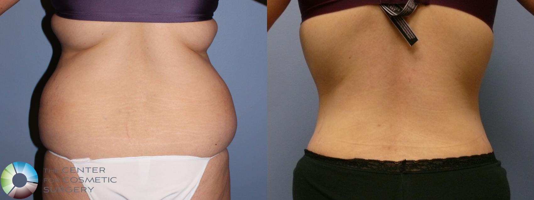 Before & After Power-assisted Liposuction Case 11413 Back in Denver and Colorado Springs, CO