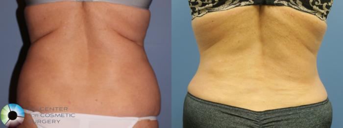 Before & After Power-assisted Liposuction Case 11415 Back in Denver and Colorado Springs, CO