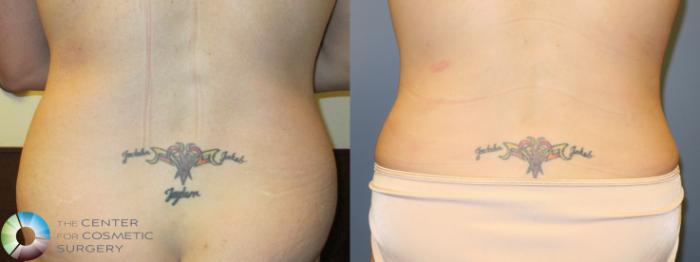 Before & After Power-assisted Liposuction Case 11416 Back in Denver and Colorado Springs, CO