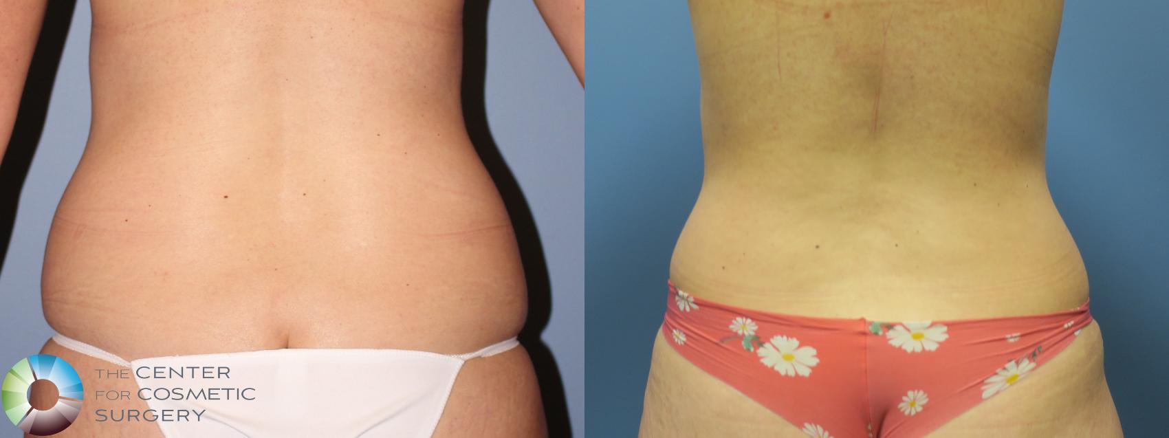 Liposuction Abdomen and Flanks Case 7001 - The Plastic Surgery Group