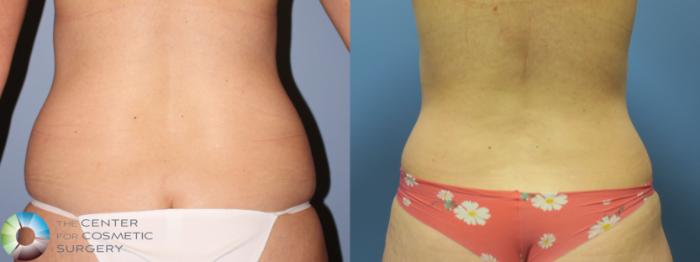 Before & After Power-assisted Liposuction Case 11629 Back View in Golden, CO
