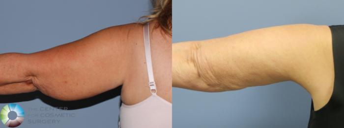 Before & After Arm Lift Case 11780 Left Posterior in Denver and Colorado Springs, CO