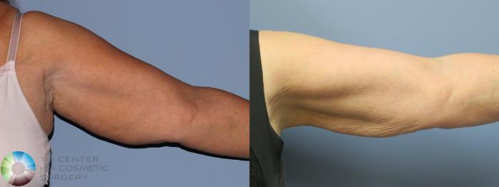 Before & After Arm Lift Case 11780 Left Side in Denver and Colorado Springs, CO