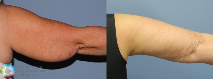 Before & After Arm Lift Case 11780 Right Posterior in Denver and Colorado Springs, CO