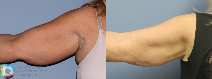 Before & After Power-assisted Liposuction Case 11780 Right Side in Denver and Colorado Springs, CO