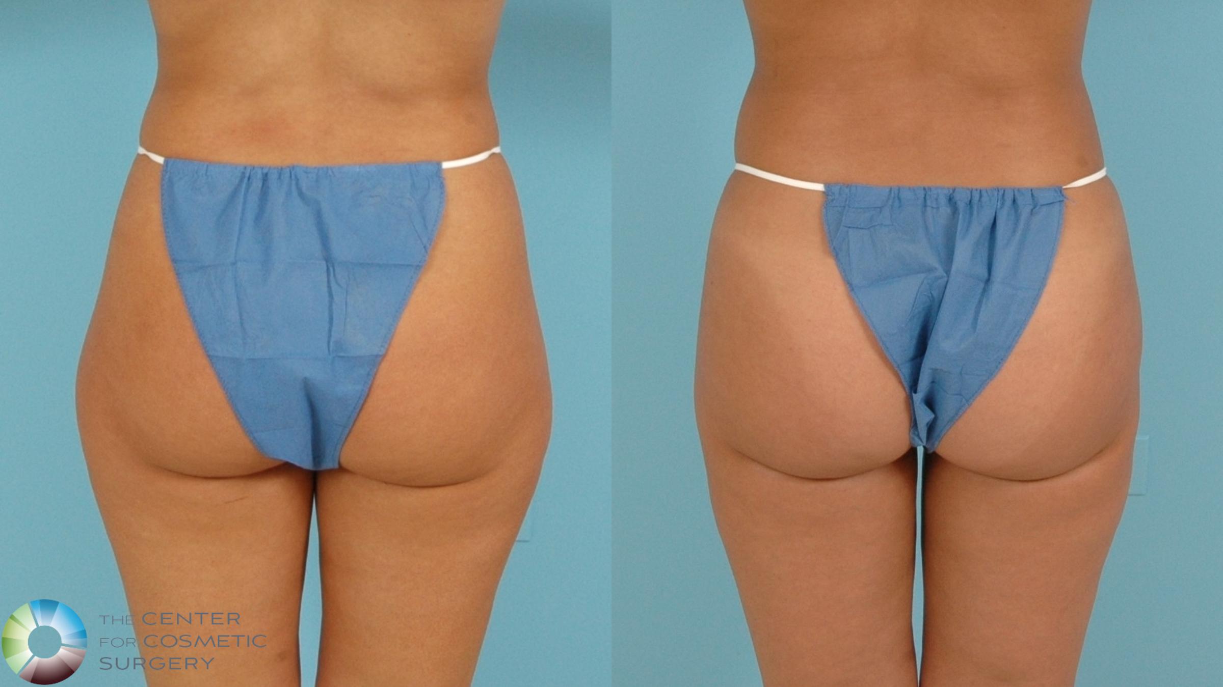 Before & After Power-assisted Liposuction Case 11841 Back View in Denver & Golden, CO
