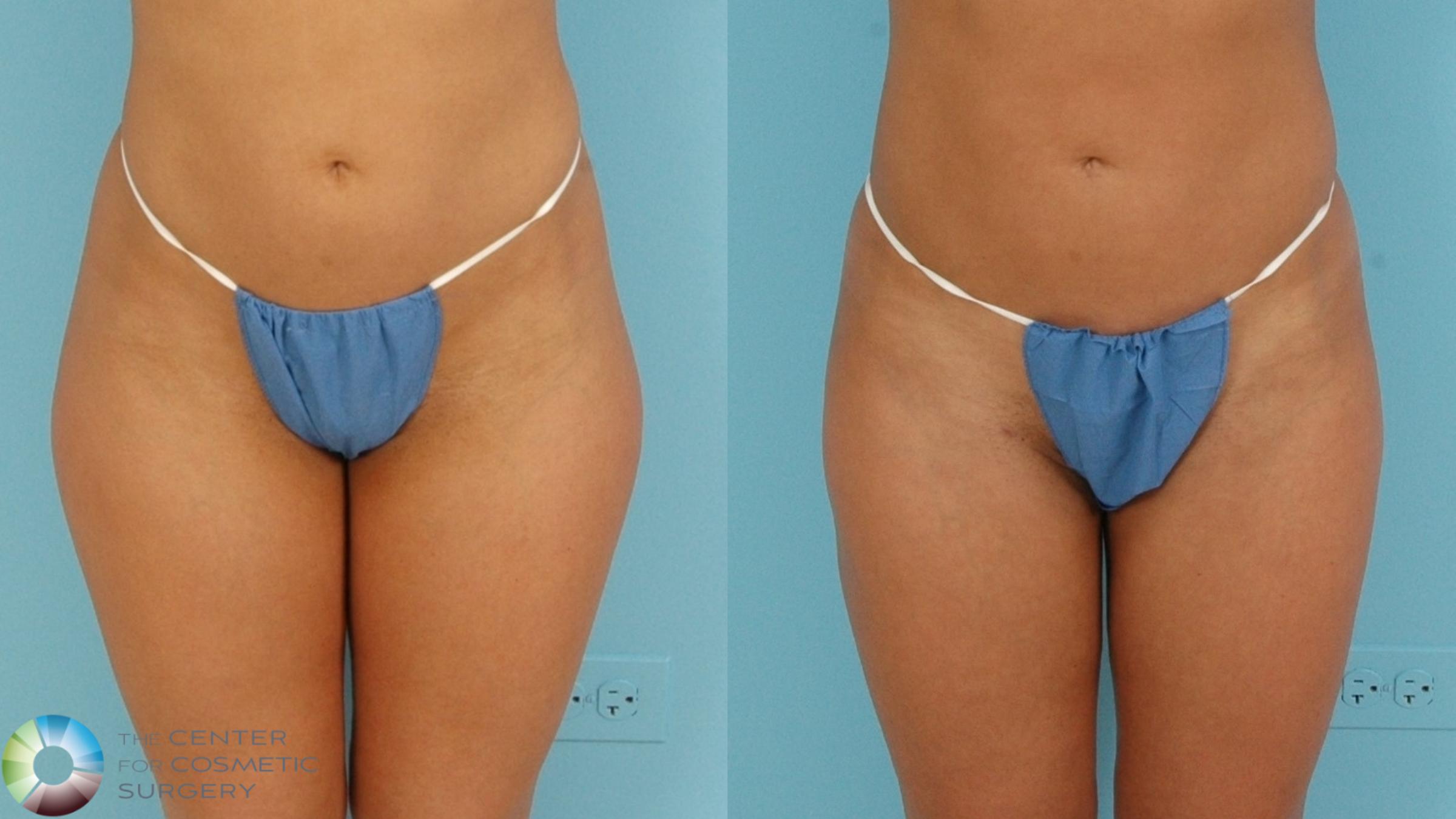 Before & After Power-assisted Liposuction Case 11841 Front View in Denver & Golden, CO