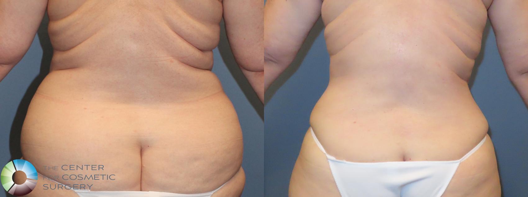 Best Denver Liposuction