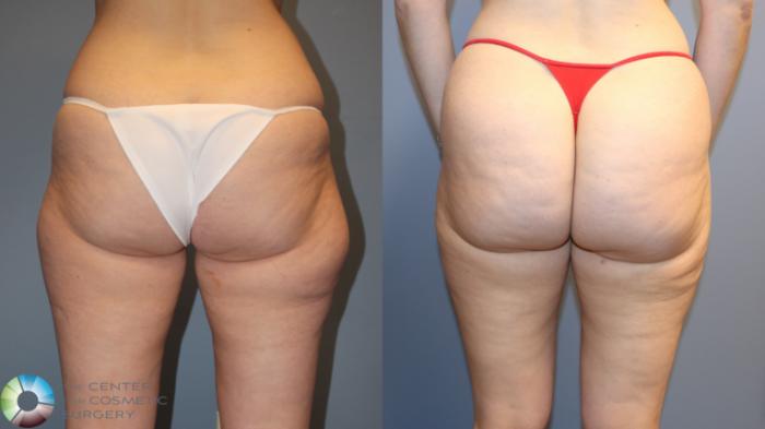 Before & After Liposuction Case 12163 Back in Denver and Colorado Springs, CO