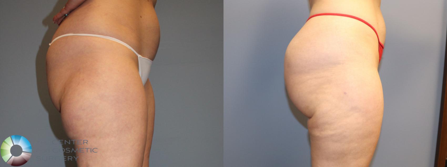 Before & After Power-Assisted Liposuction Case 12163 Right Side in Denver and Colorado Springs, CO