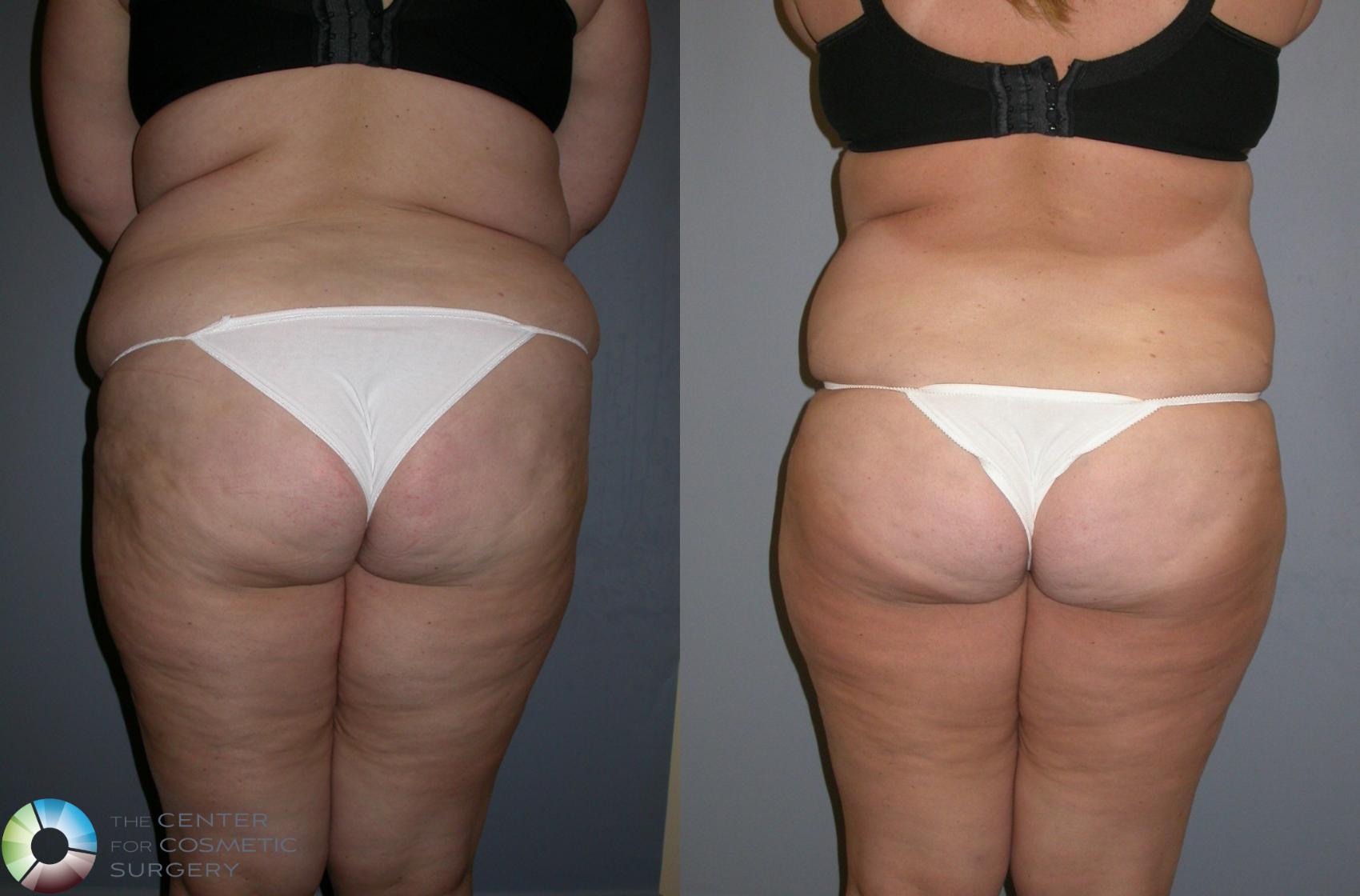 Before & After Liposuction Case 133 View #1 in Denver and Colorado Springs, CO