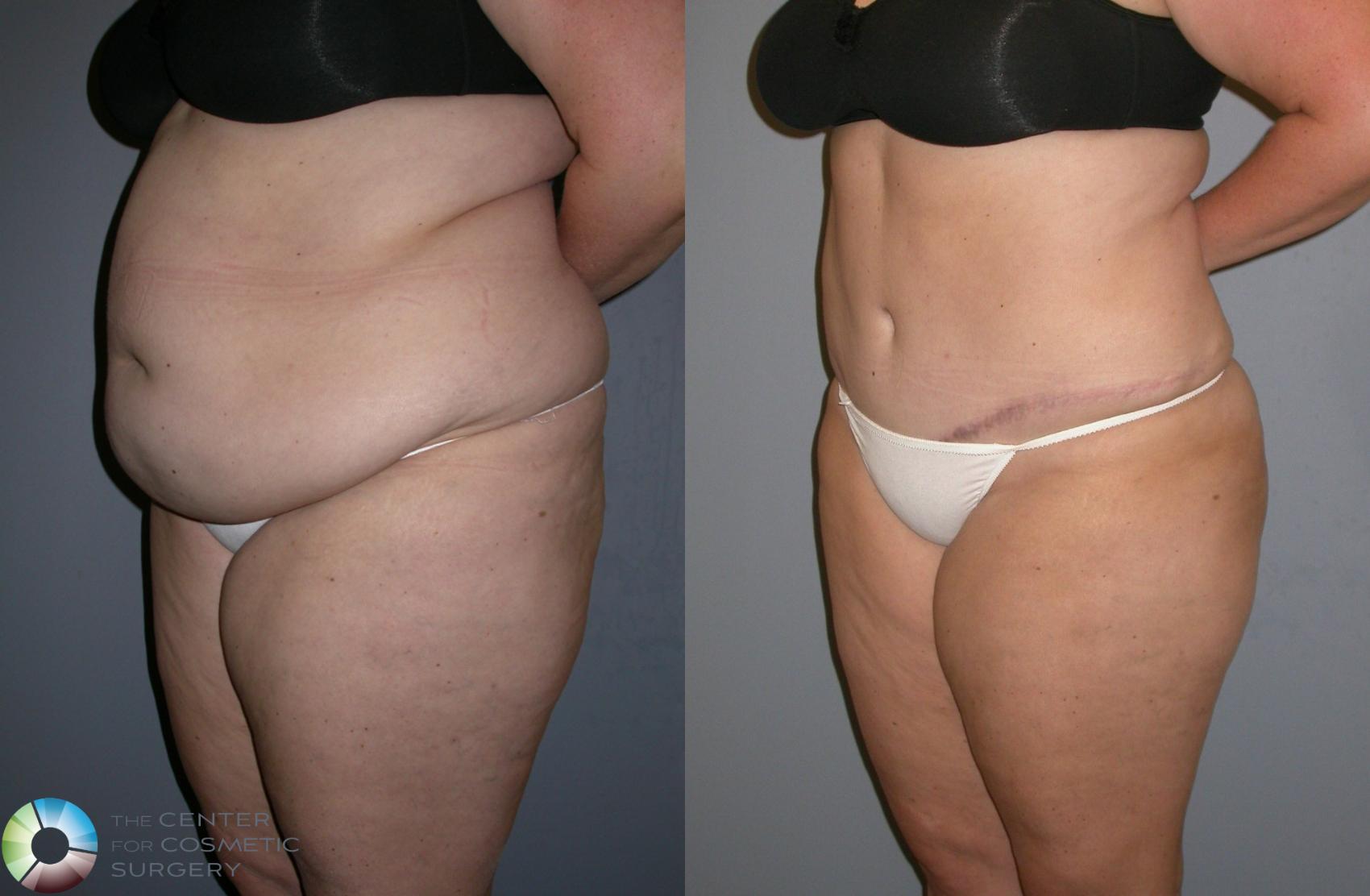 Before & After Power-Assisted Liposuction Case 133 View #2 in Denver and Colorado Springs, CO