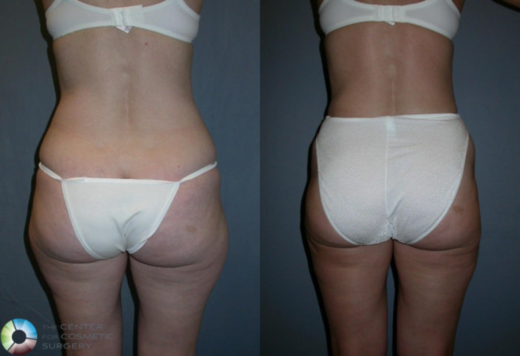 Before & After Liposuction Case 17 View #1 in Denver and Colorado Springs, CO