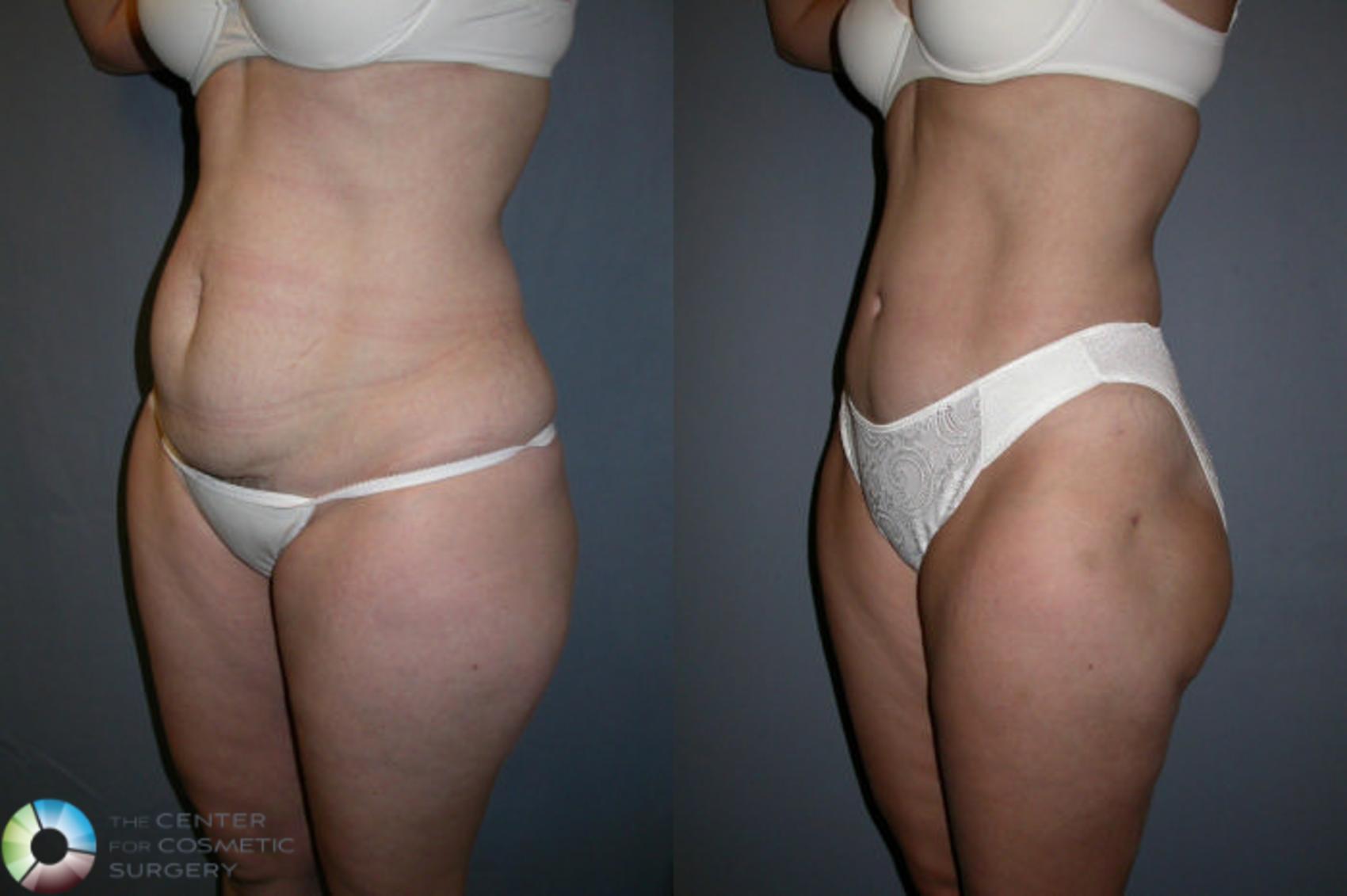 Before & After Power-Assisted Liposuction Case 17 View #2 in Denver and Colorado Springs, CO