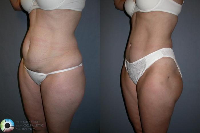 Before & After Power-assisted Liposuction Case 17 View #2 View in Golden, CO
