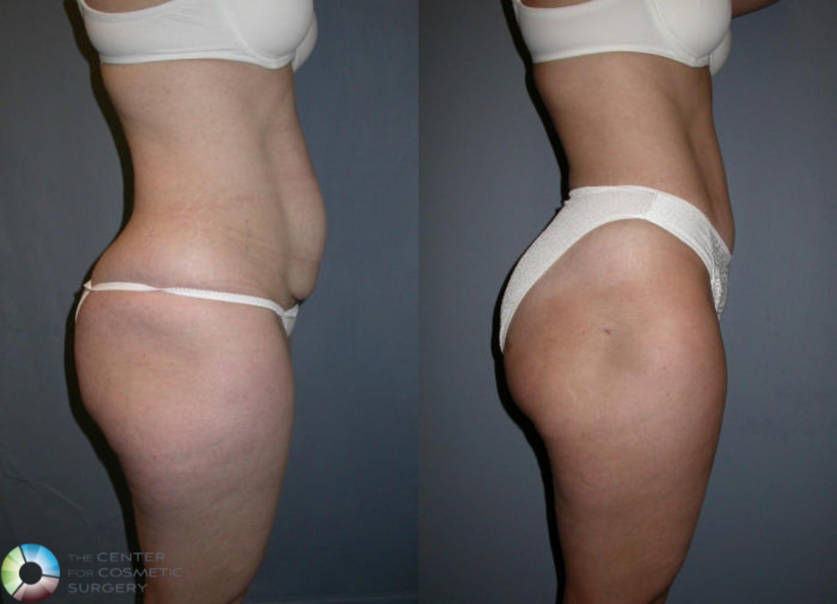 Before & After Power-Assisted Liposuction Case 17 View #3 in Denver and Colorado Springs, CO