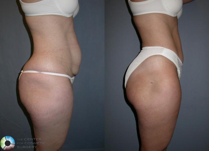 Before & After Liposuction Case 17 View #3 View in Golden, CO