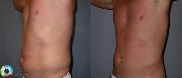 Before & After Power-assisted Liposuction Case 31 View #2 in Denver, CO