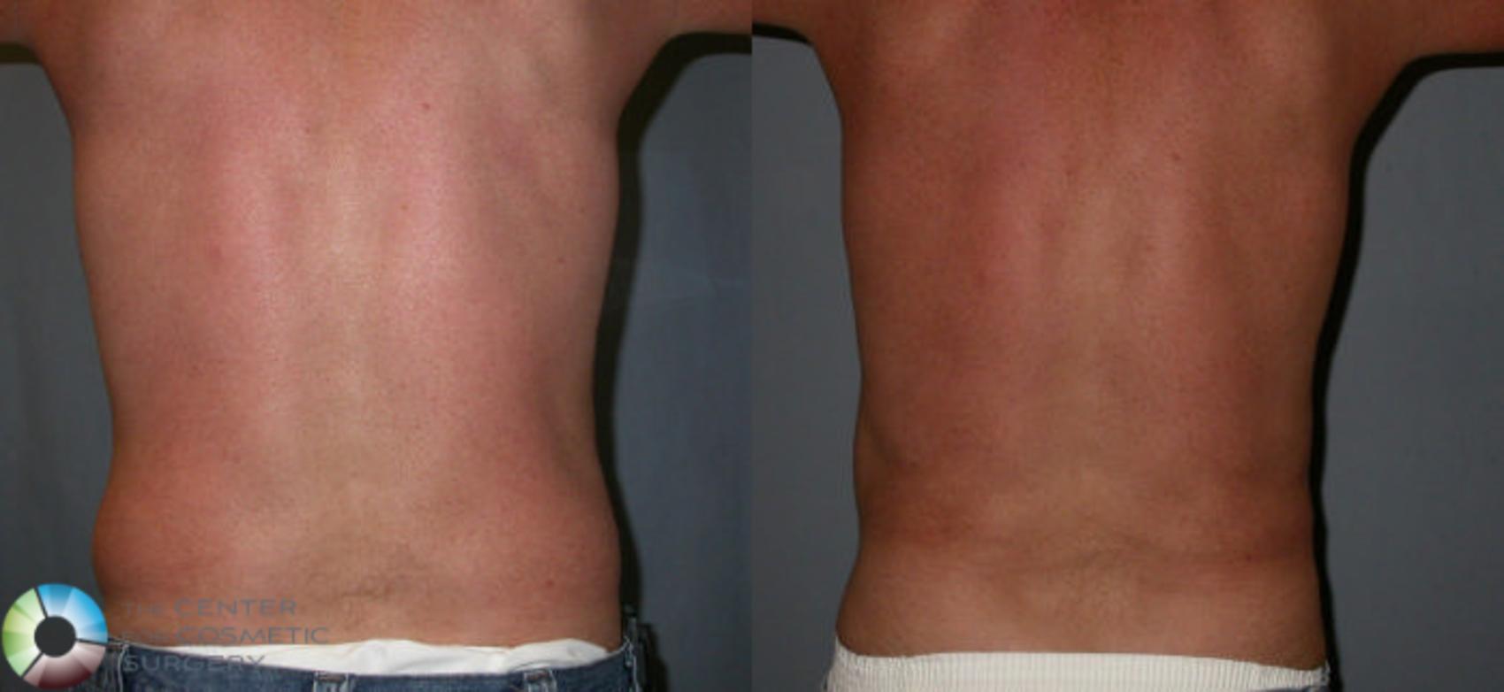 Before & After Power-Assisted Liposuction Case 31 View #3 in Denver and Colorado Springs, CO
