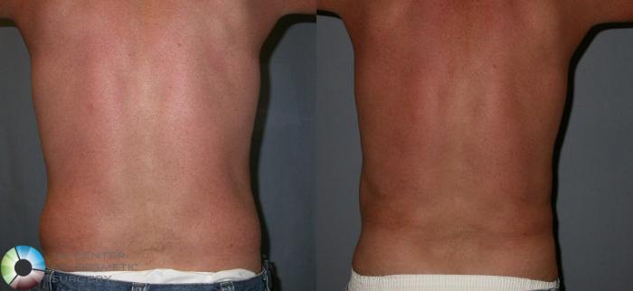 Before & After Liposuction Case 31 View #3 in Denver and Colorado Springs, CO