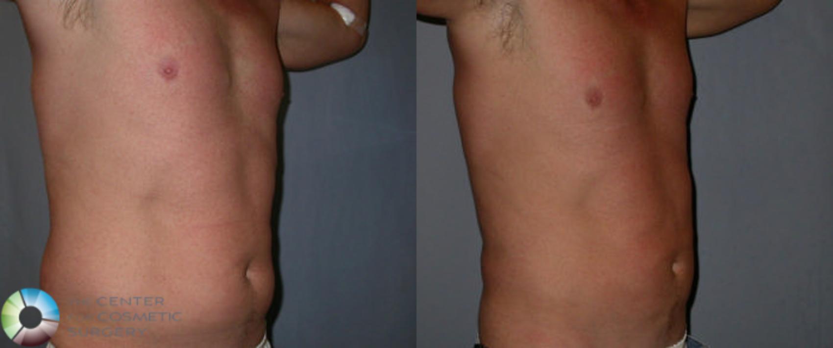 Before & After Power-Assisted Liposuction Case 31 View #4 in Denver and Colorado Springs, CO