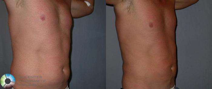 Before & After Liposuction Case 31 View #4 in Denver and Colorado Springs, CO