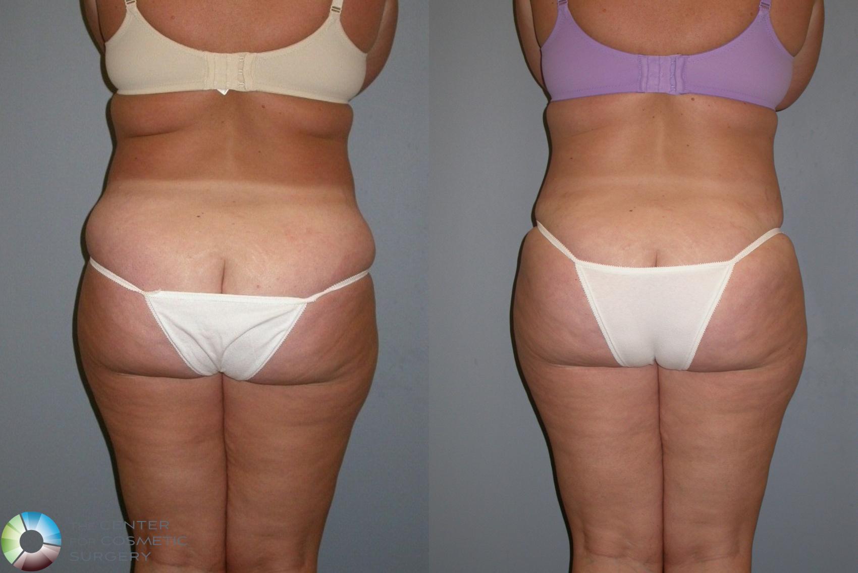 Before & After Liposuction Case 440 View #1 in Denver and Colorado Springs, CO