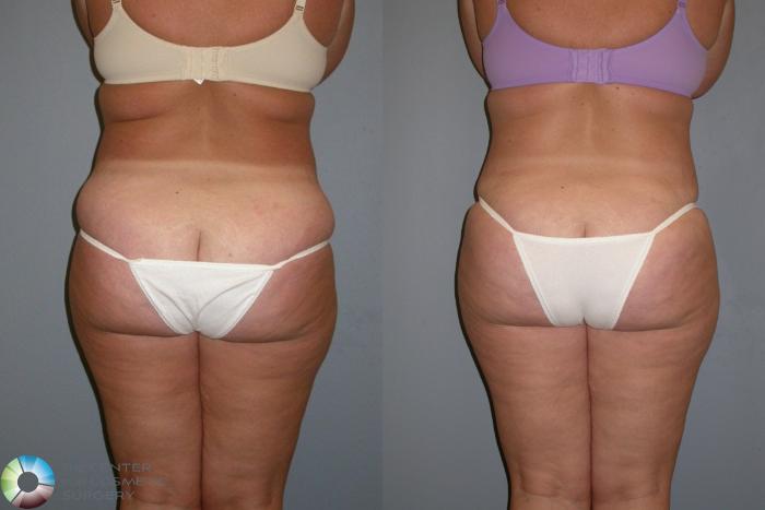 Before & After Power-assisted Liposuction Case 440 View #1 View in Golden, CO
