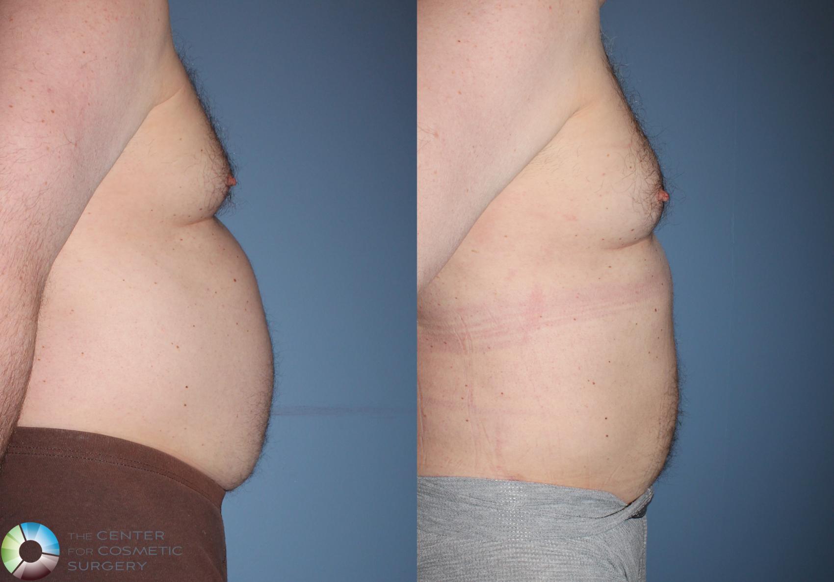 Before & After Power-assisted Liposuction Case 825 View #2 View in Denver & Golden, CO