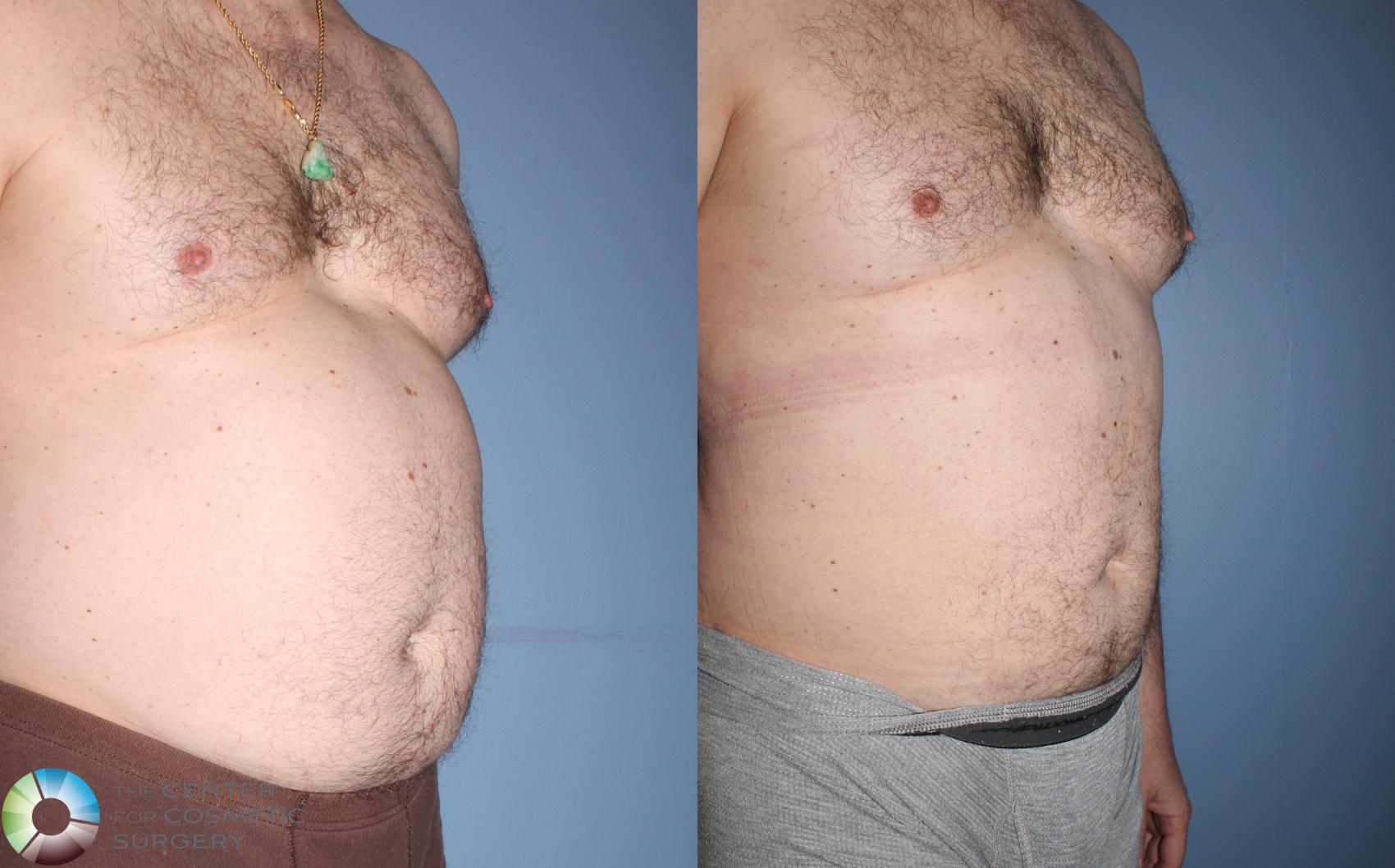 Before & After Power-assisted Liposuction Case 825 View #3 View in Denver & Golden, CO